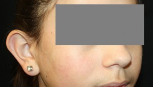 Otoplasty Before & After Patient #21512