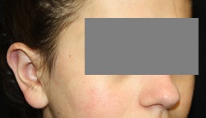 Otoplasty Before & After Patient #21512