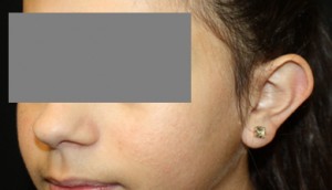 Otoplasty Before & After Patient #21512