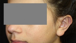 Otoplasty Before & After Patient #21512