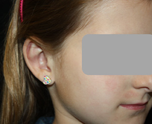 Otoplasty Before & After Patient #21521
