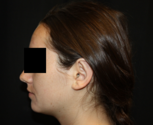 Otoplasty Before & After Patient #21535