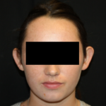 Otoplasty Before & After Patient #21535