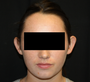 Otoplasty Before & After Patient #21535