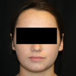 Otoplasty Before & After Patient #21535