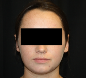 Otoplasty Before & After Patient #21535