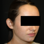 Otoplasty Before & After Patient #21535