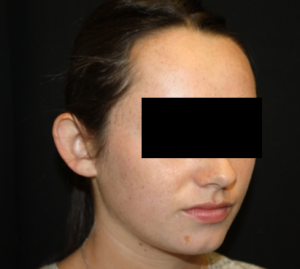 Otoplasty Before & After Patient #21535