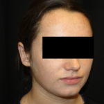 Otoplasty Before & After Patient #21535