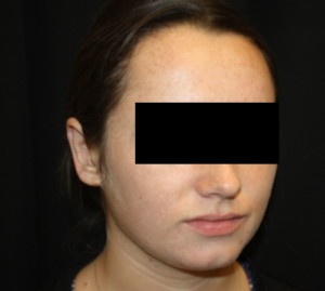 Otoplasty Before & After Patient #21535