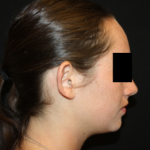 Otoplasty Before & After Patient #21535