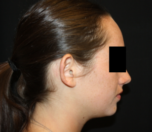 Otoplasty Before & After Patient #21535