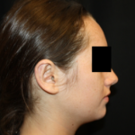 Otoplasty Before & After Patient #21535