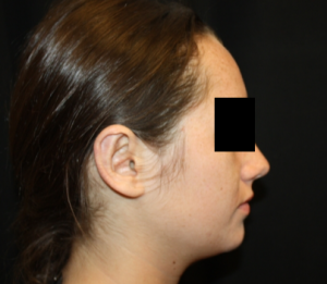 Otoplasty Before & After Patient #21535