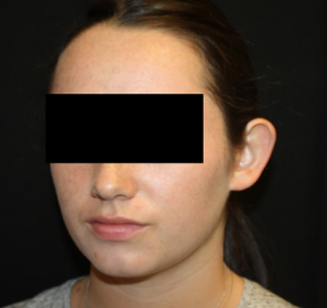 Otoplasty Before & After Patient #21535