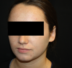 Otoplasty Before & After Patient #21535