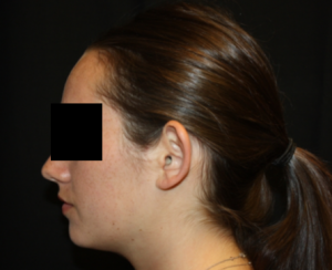 Otoplasty Before & After Patient #21535