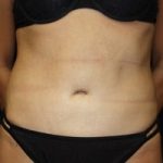 Tummy Tuck Before & After Patient #21546