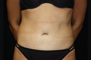 Tummy Tuck Before & After Patient #21546