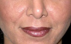 Lip Augmentation Before & After Patient #21664