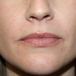 Lip Augmentation Before & After Patient #21654