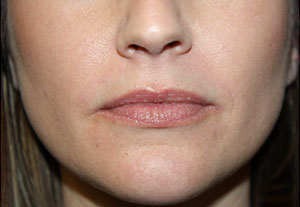 Lip Augmentation Before & After Patient #21654