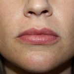 Lip Augmentation Before & After Patient #21654