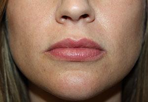 Lip Augmentation Before & After Patient #21654