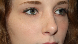 Rhinoplasty Before & After Patient #22169
