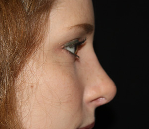 Rhinoplasty Before & After Patient #22169