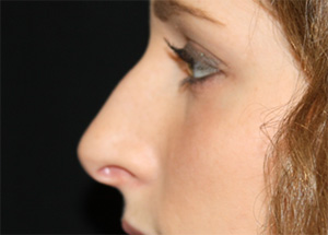 Rhinoplasty Before & After Patient #22169