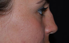 Rhinoplasty Before & After Patient #22178