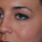 Rhinoplasty Before & After Patient #22178