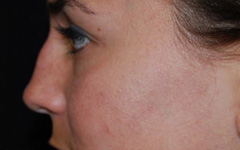 Rhinoplasty Before & After Patient #22178