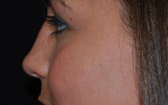 Rhinoplasty Before & After Patient #22178