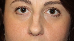 Rhinoplasty Before & After Patient #22187