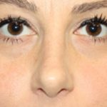 Rhinoplasty Before & After Patient #22187