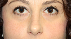 Rhinoplasty Before & After Patient #22187