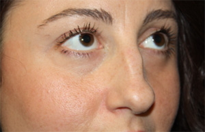 Rhinoplasty Before & After Patient #22187