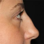 Rhinoplasty Before & After Patient #22187