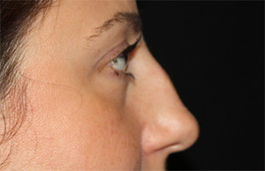 Rhinoplasty Before & After Patient #22187