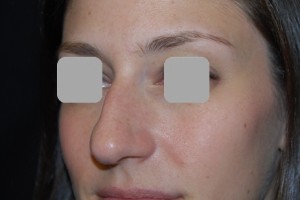 Rhinoplasty Before & After Patient #22198