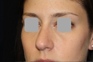 Rhinoplasty Before & After Patient #22198