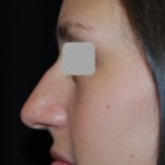 Rhinoplasty Before & After Patient #22198