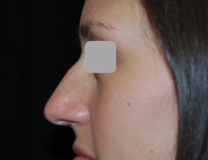 Rhinoplasty Before & After Patient #22198