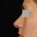 Rhinoplasty Before & After Patient #22198