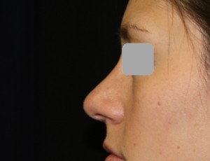 Rhinoplasty Before & After Patient #22198