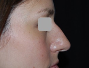 Rhinoplasty Before & After Patient #22198