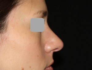 Rhinoplasty Before & After Patient #22198