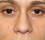 Rhinoplasty Before & After Patient #22207